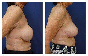 Breast revision surgery Los Angeles