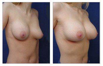 Breast Augmentation Revision Of Deflated Implants