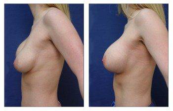 left view Breast Augmentation Revision Of Deflated Implant