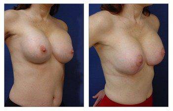 Best Breast Augmentation Surgeon