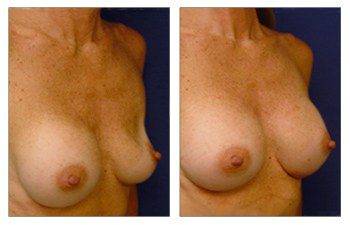 Breast Augmentation Surgery Newport Beach