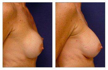 Breast Implants San Diego