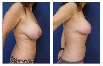 Breast Augmentation Surgery