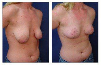 Is Breast Lift Safe, CPSI.