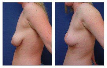 Is Breast Lift Safe, CPSI.