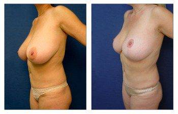 Breast Lift Surgery