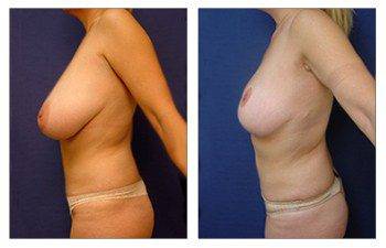 How Does Breast Lift work, CPSI.