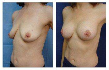 When Is A Breast Lift Covered By Insurance, CPSI.