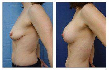 When Is A Breast Lift Covered By Insurance, CPSI.