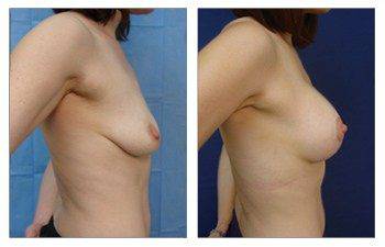 When Is A Breast Lift Covered By Insurance, CPSI.