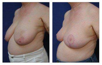 Where Are Breast Lift Scars, CPSI.