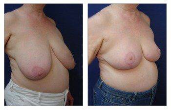 Where Are Breast Lift Scars, CPSI.