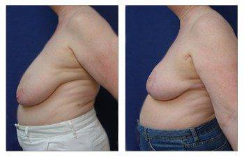 Where Are Breast Lift Scars, CPSI.