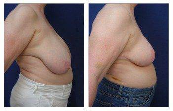 Where Are Breast Lift Scars, CPSI.