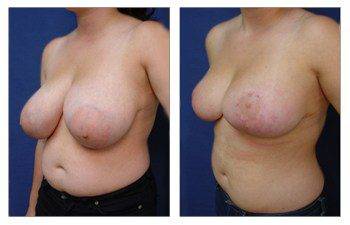 When Do Breast Lift Scars Fade, CPSI.