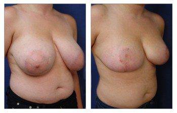 When Do Breast Lift Scars Fade, CPSI.