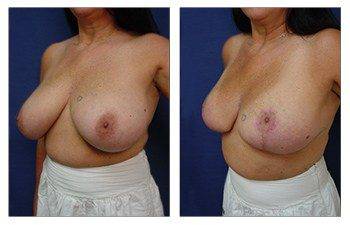 When Do Breast Lift Scars Fade, CPSI.