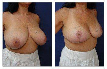 When Do Breast Lift Scars Fade, CPSI.