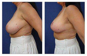 When Do Breast Lift Scars Fade, CPSI.