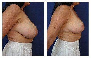 When Do Breast Lift Scars Fade, CPSI.