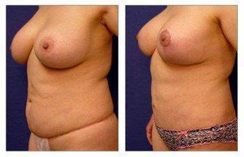 Breast Lift with Implant Augmentation Revision Newport Beach