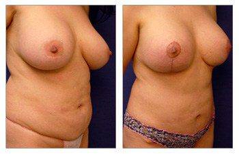 Breast asymmetry Dana Point - Breast Lift with Implant Augmentation Revision