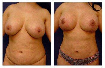 Breast Lift Surgery