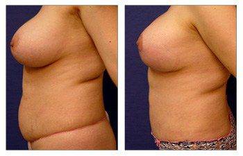 Saline implants San Diego - Breast Lift with Implant Augmentation Revision