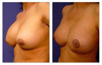 Breast Lift with Implant to Correct Nipple Position Asymmetry