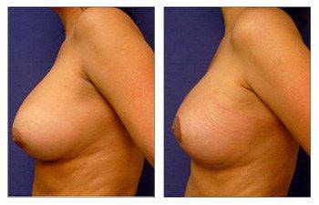 Breast lift with an Implant Newport Beach