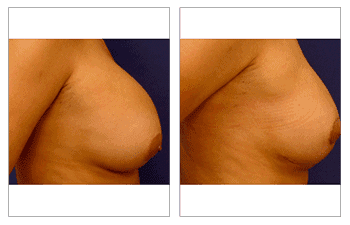 Breast Augmentation Dana Point - Correct Nipple Position Asymmetry procedure