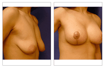 Breast augmentation Laguna Beach