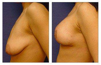 Correct Breast Sagging Beverly Hills