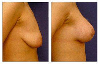 Breast Lift with Implant to Correct Breast Sagging