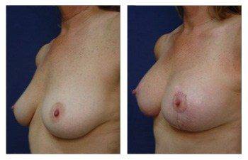 left front oblique How To Get Cleavage With A Breast Lift With Implant Augmentation