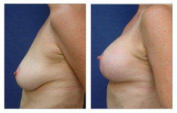 How To Get Cleavage With A Breast Lift With Implant Augmentation