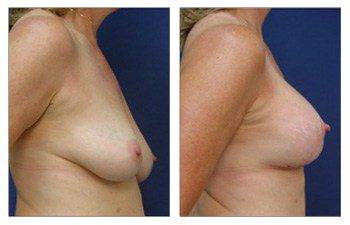 right view How To Get Cleavage With A Breast Lift With Implant Augmentation