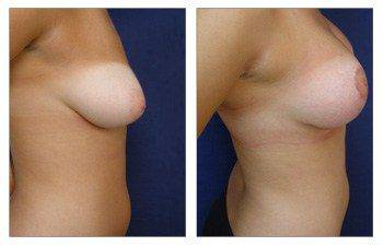 Breast enhancement Los Angeles