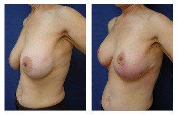 Breast Lift With Implant Augmentation To Decrease Areola Size