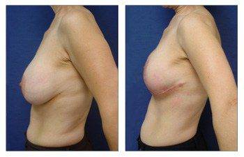 Breast Lift With Implant Augmentation To Decrease Areola Size