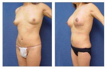 Breast Augmentation with Silicone Gel Implants 