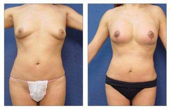 Breast Lift with Implant Augmentation to Increase Breast Mound Size, CPSI