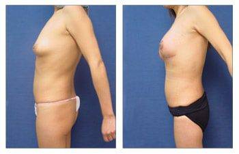 Breast Lift Beverly Hills