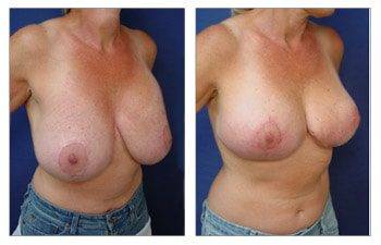 Breast Deformity Beverly Hills