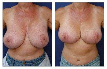 Breast Lift With Implant Augmentation To Correct Breast Deformity, CPSI