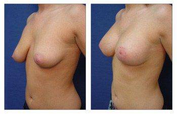 Breast Lift with Implant Augmentation Beverly Hills