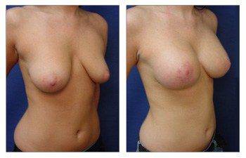 right front oblique Breast Lift With Implant Augmentation Beverly Hills