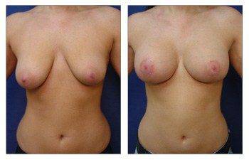 front viw Breast Lift With Implant Augmentation Beverly Hills