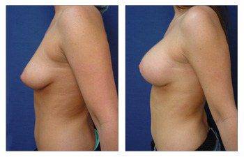 Breast Lift with Implant Augmentation Beverly Hills