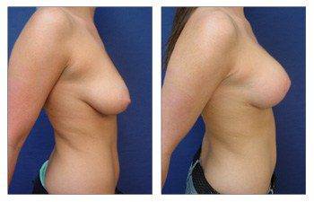 right view Breast Lift With Implant Augmentation Beverly Hills